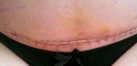 3-THINGS-EVERYONE-MUST-LEARN-ABOUT-WOMEN-WHO-HAD-C-SECTION